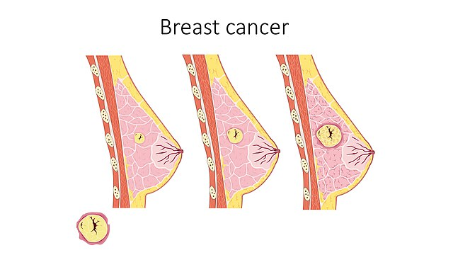 A diagram of a person's breast Description automatically generated