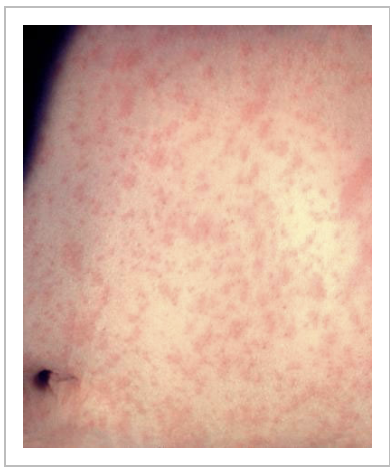 Close-up of a person's skin Description automatically generated